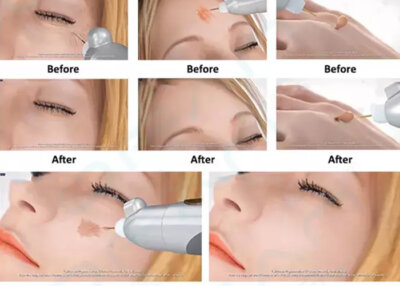 Difference between fractional plasma lift and thermage