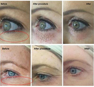 Fractional plasma ozone function